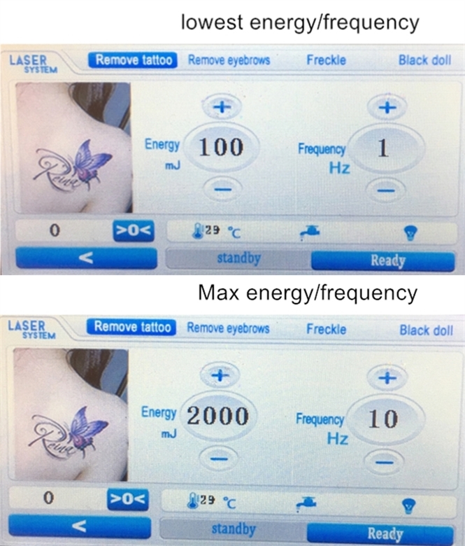 tattoo removal machine nd yag laser black doll treatment