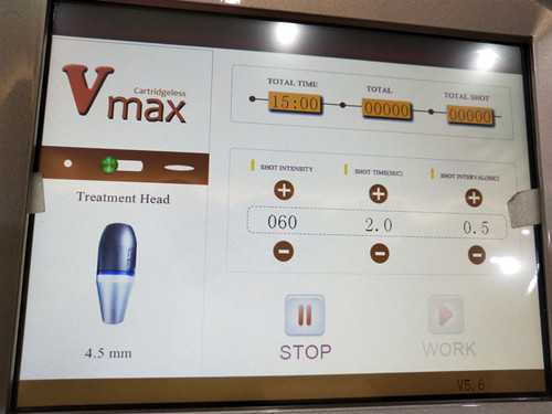 Vmax hifu Radar line carve ultrasound machine for face skin tighten and lifting