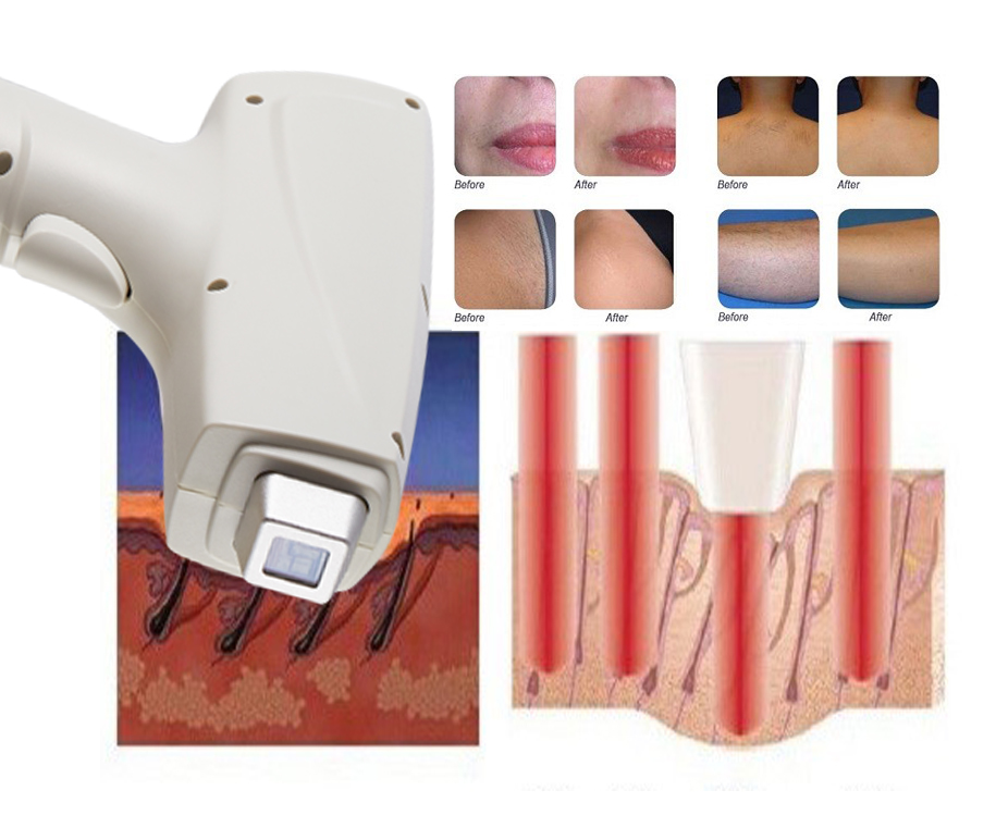 Permanent hair removal/laser epilator hair removal/808nm diode laser hair removal machine