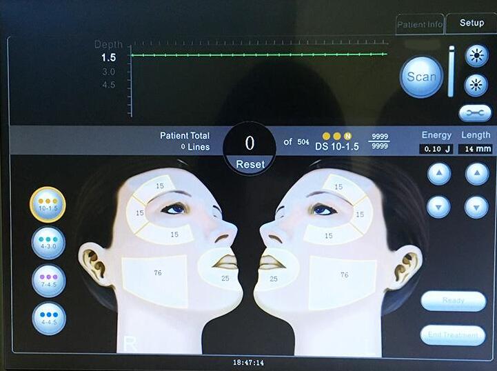 Wrinkle removal High intensity focused ultrasound HIFU face lift machine