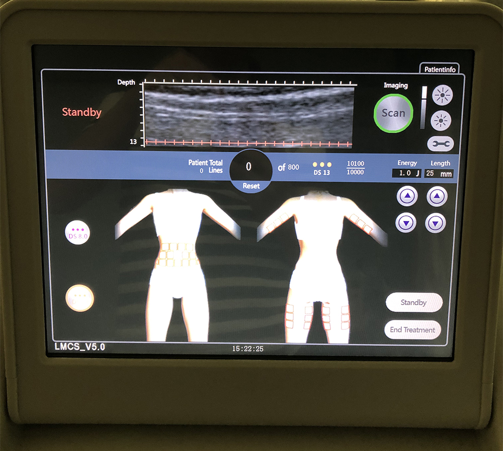 Tingmay High Intensity Focused Ultrasound HIFU Korea Machine Face Lifting