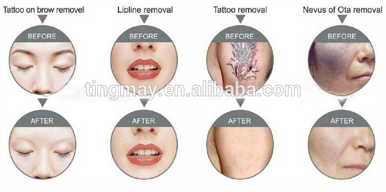 ND yag laser parts / laser tattoo removal machine / nd yag laser for tattoo removal&pigment therapy