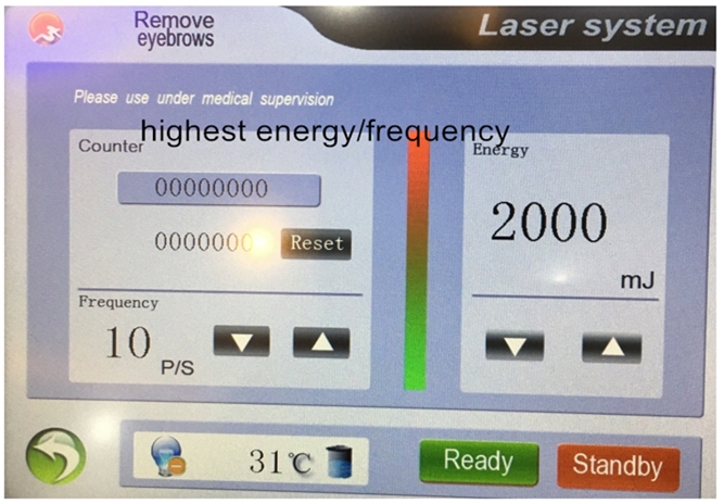 new design 10hz 2000mj big screen multi-language nd yag laser tattoo removal laser machine